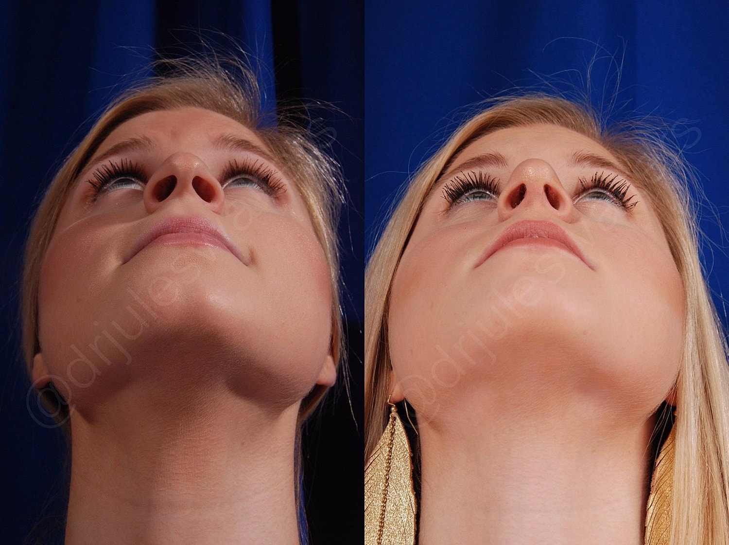 Rhinoplasty Before & After