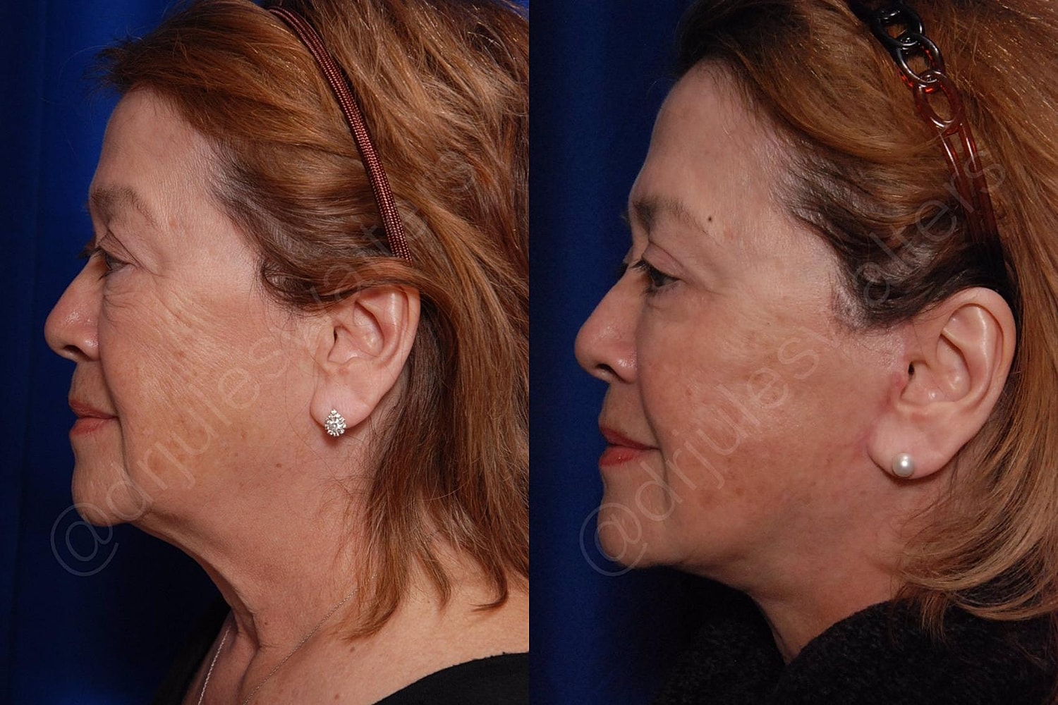 Facelift Before & After