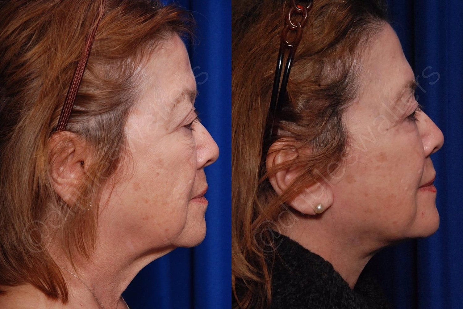 Facelift Before & After