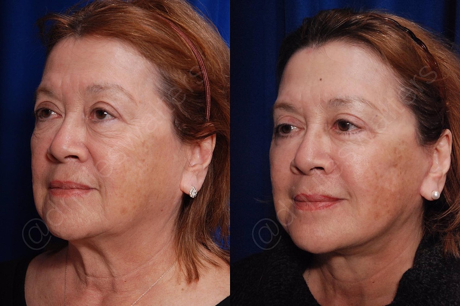Facelift Before & After