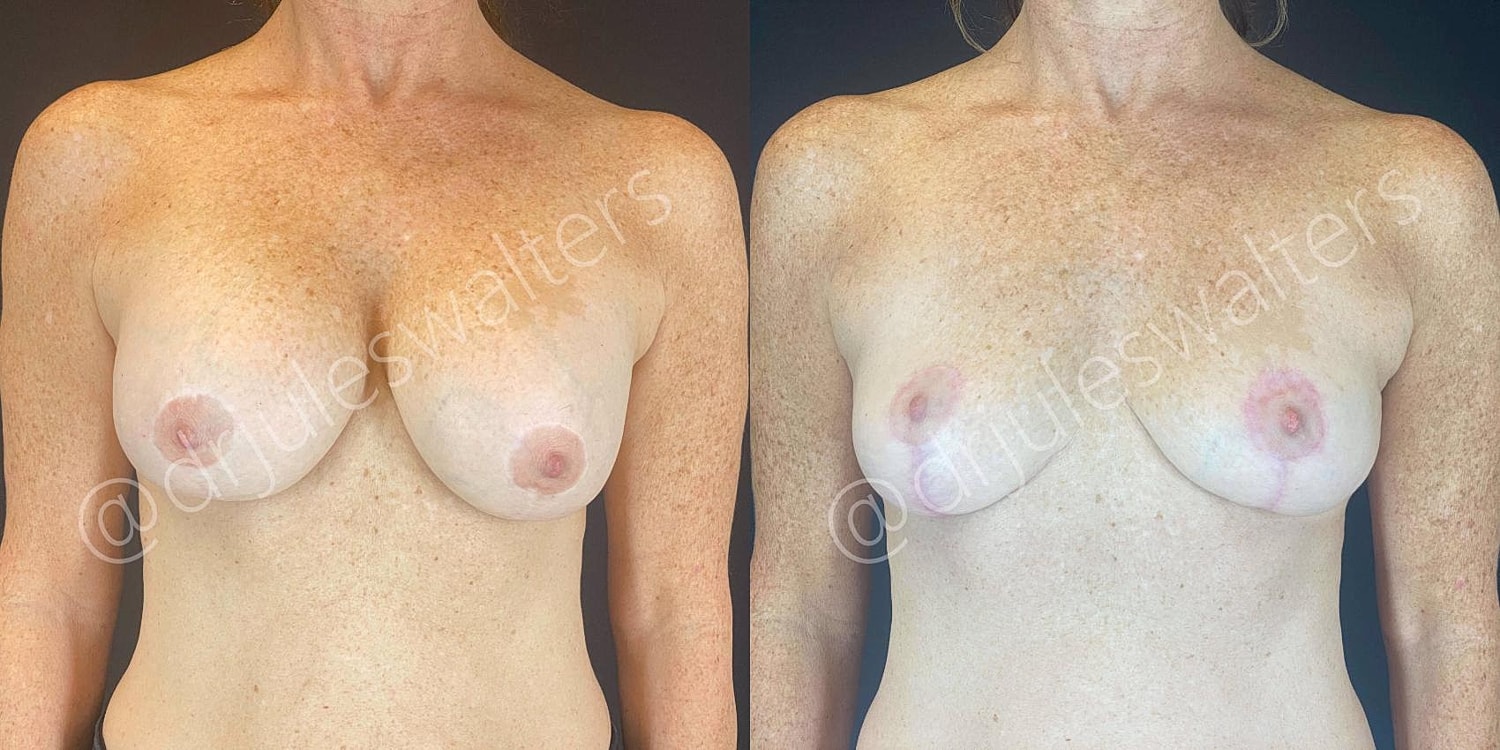 Breast Lift Before & After