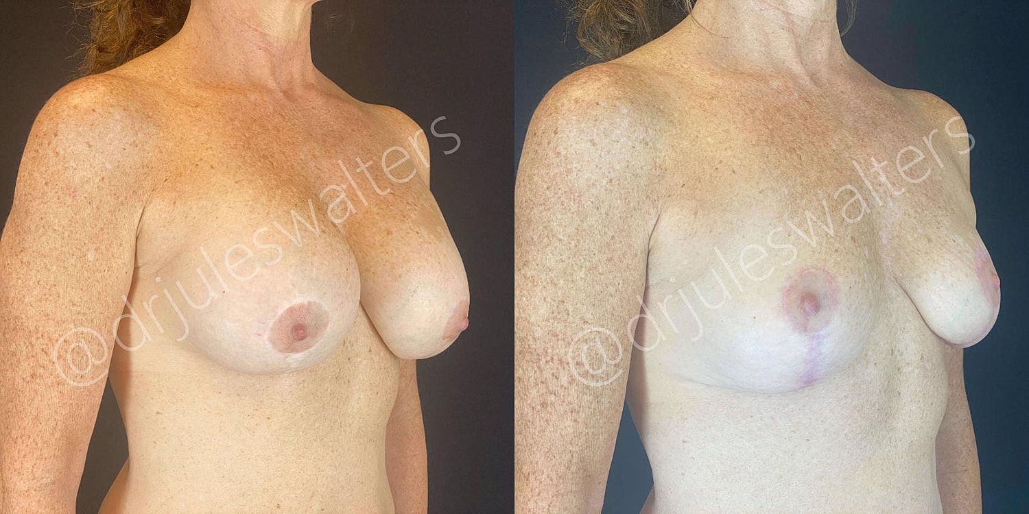 Breast Lift Before & After