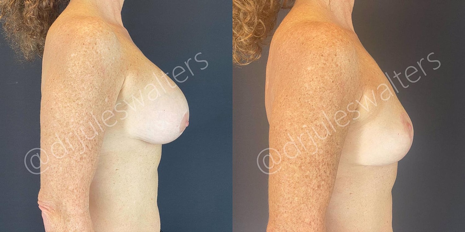 Breast Lift Before & After
