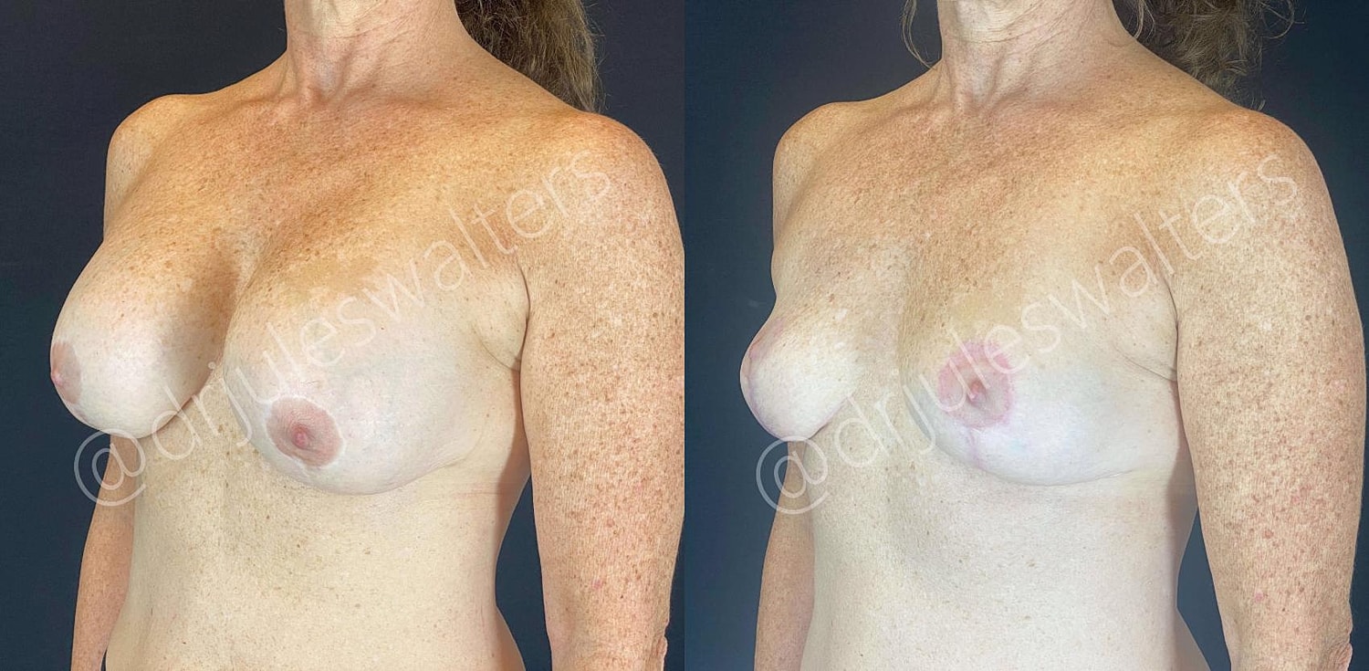 Breast Lift Before & After