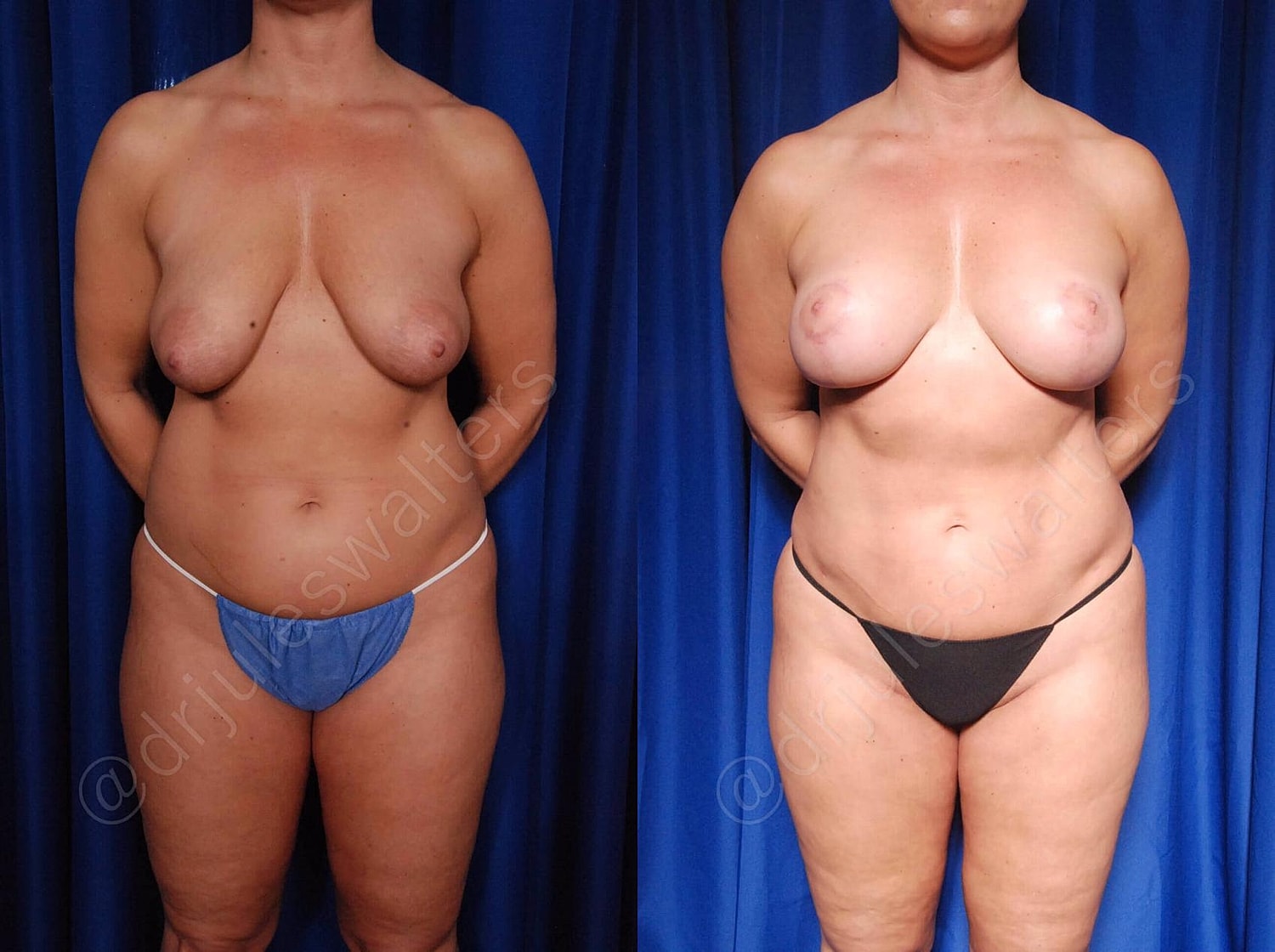 Breast Lift Before & After