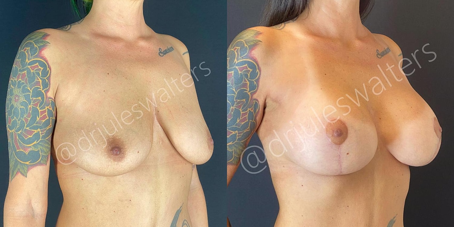 Breast Lift Before & After