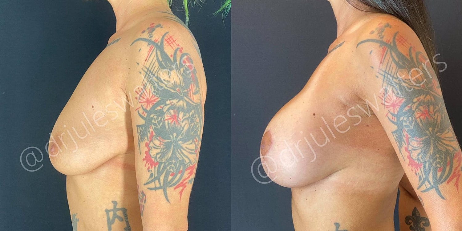 Breast Lift Before & After