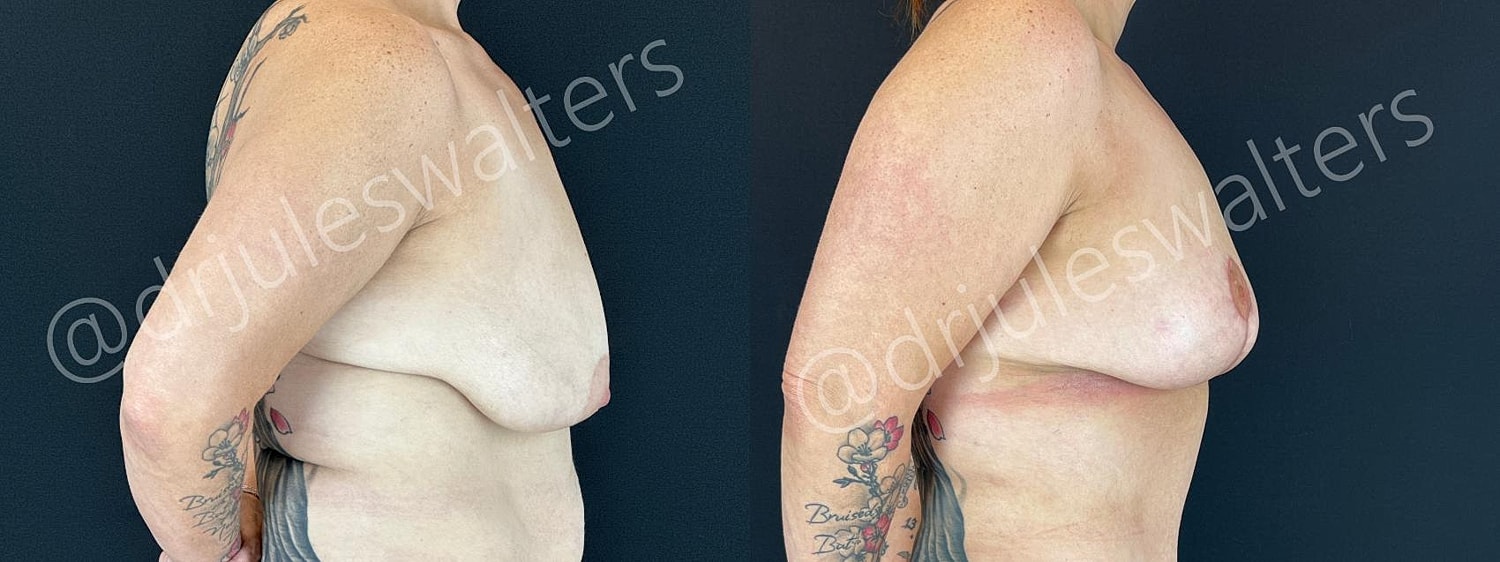 Breast Lift Before & After