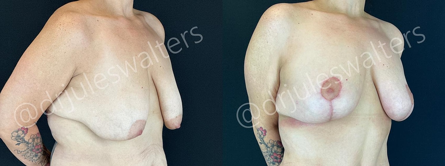 Breast Lift Before & After