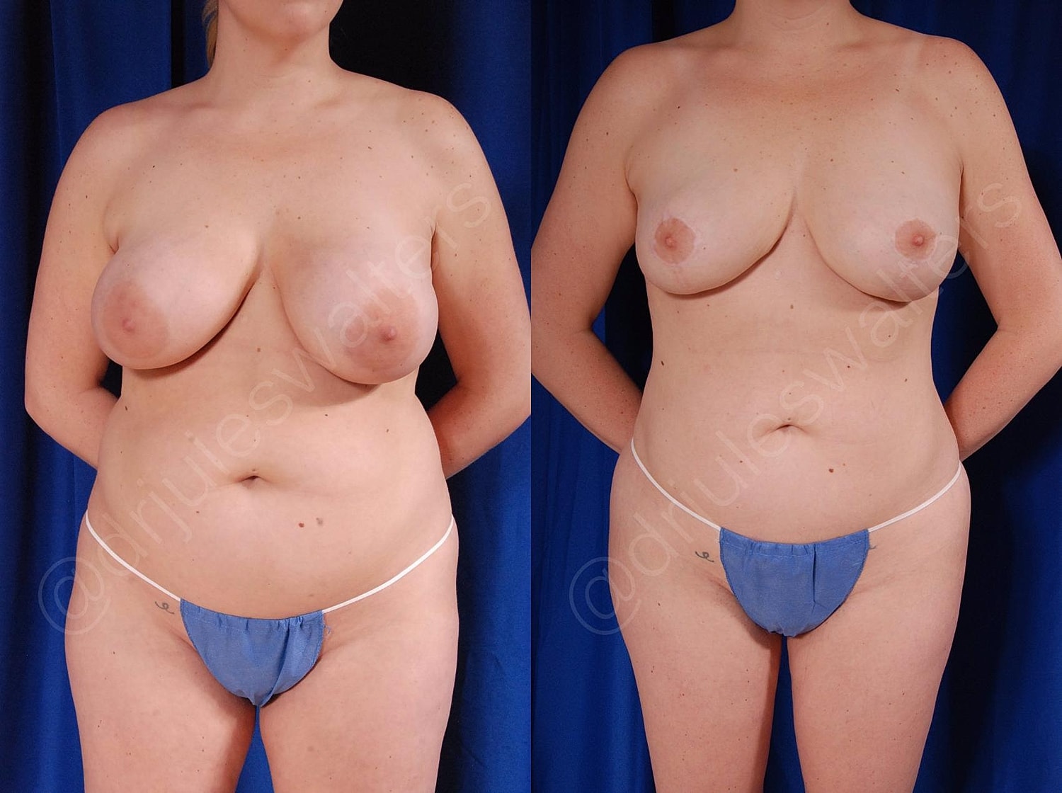 Breast Lift Before & After