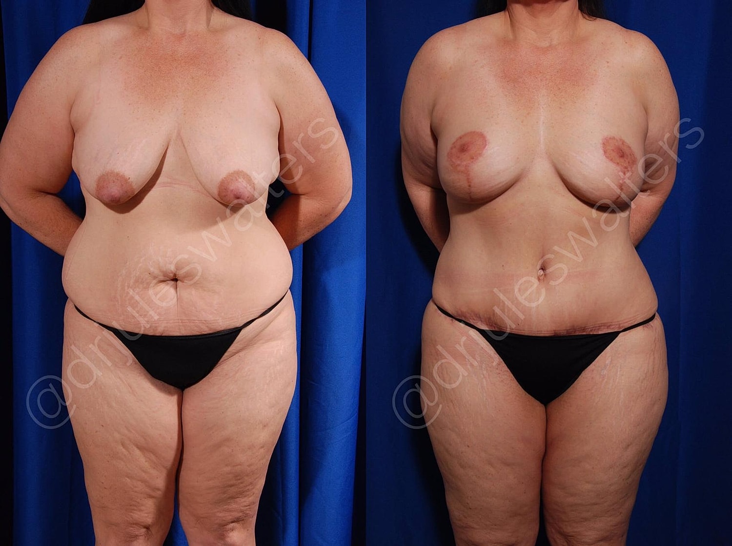 Breast Lift Before & After