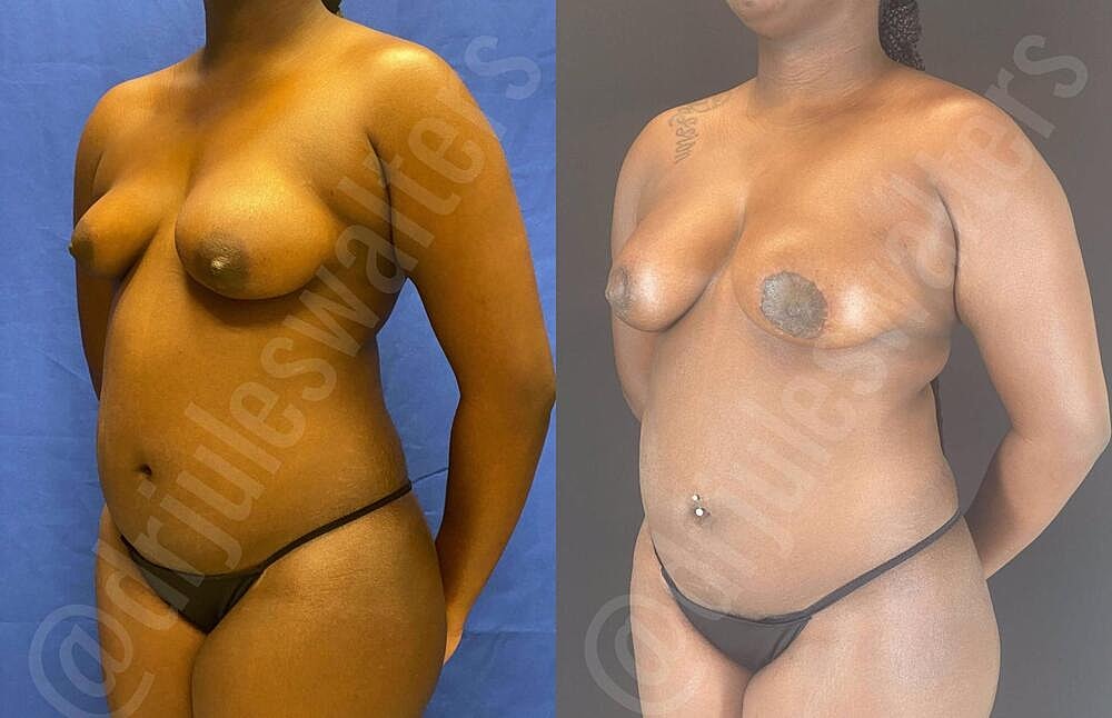 Breast Lift Before & After