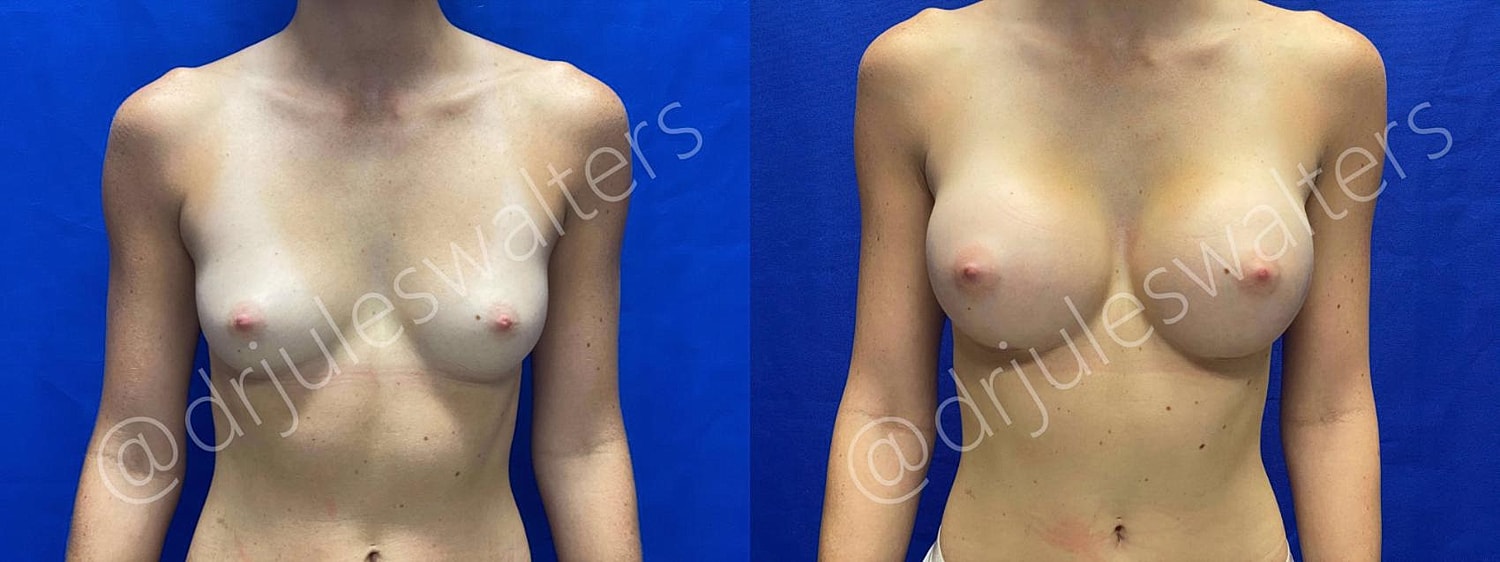 Breast Augmentation Before & After