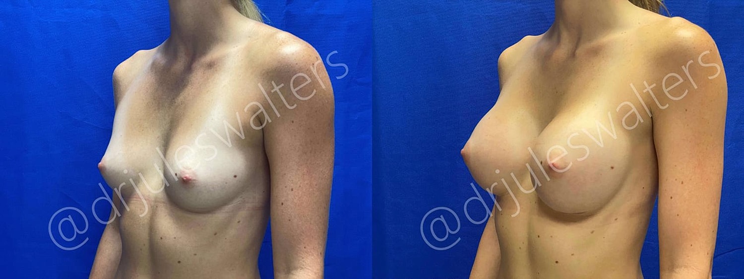 Breast Augmentation Before & After