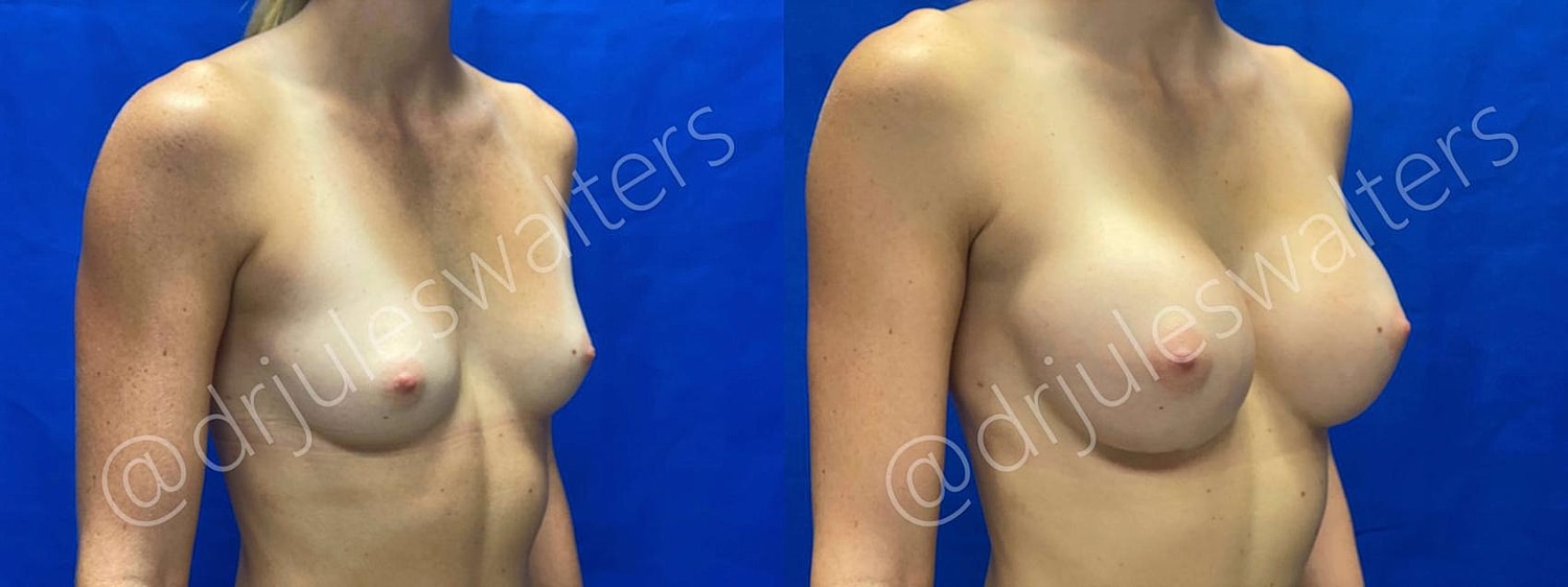 Breast Augmentation Before & After