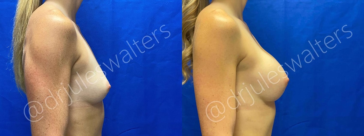 Breast Augmentation Before & After