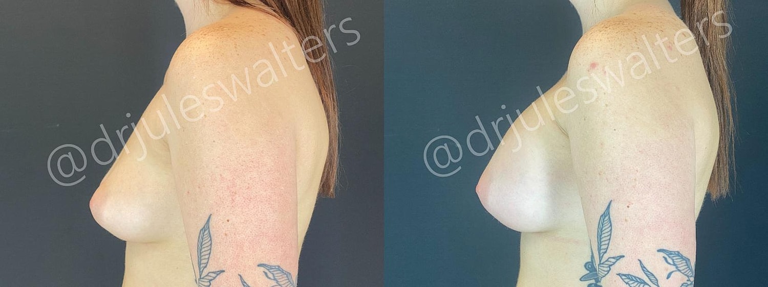 Breast Augmentation Before & After