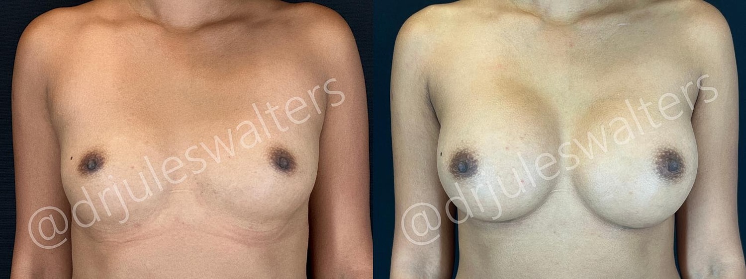 Breast Augmentation Before & After