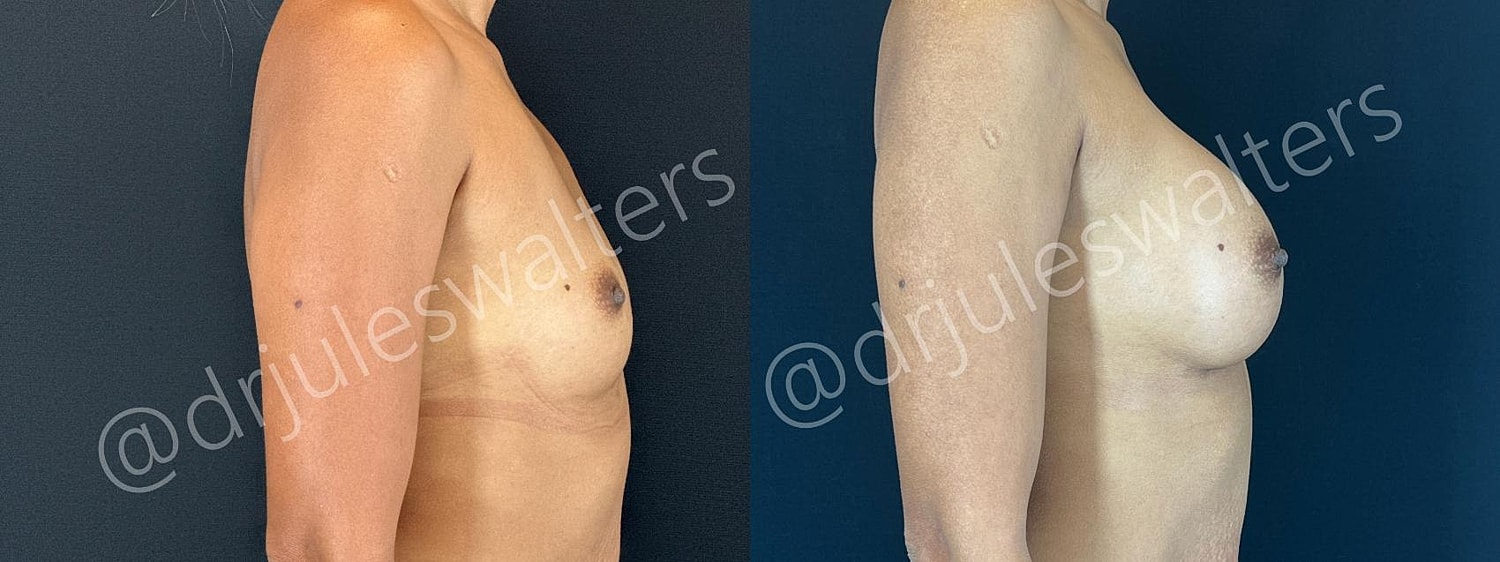 Breast Augmentation Before & After