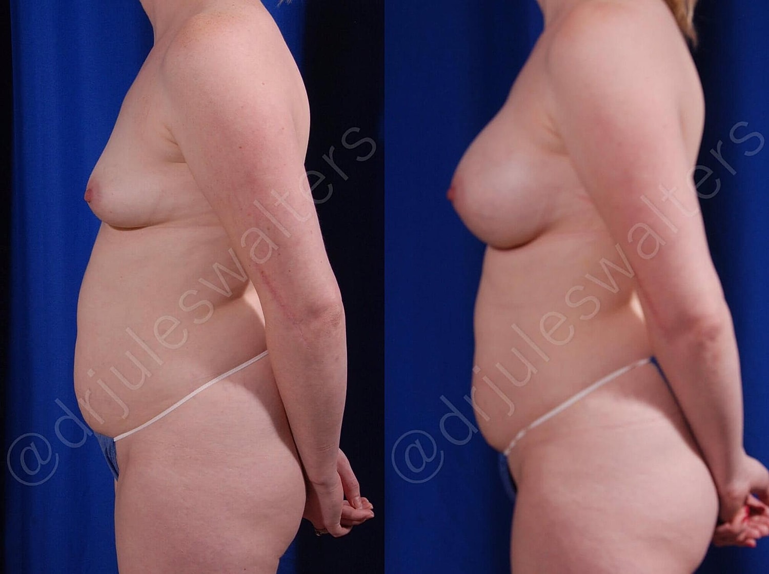 Breast Augmentation Before & After