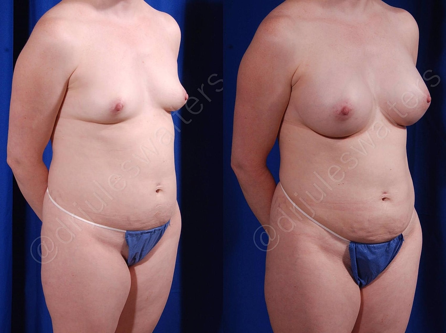 Breast Augmentation Before & After