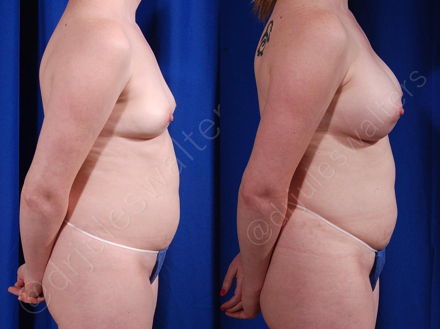 Breast Augmentation Before & After