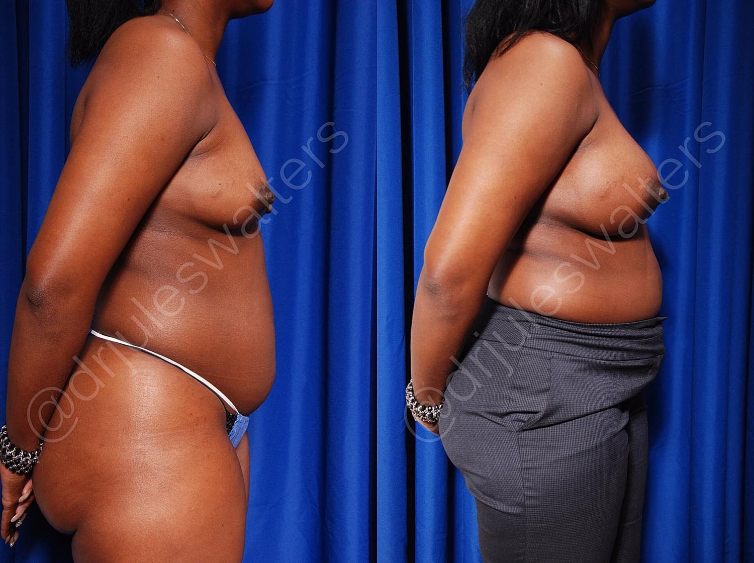 Breast Augmentation Before & After