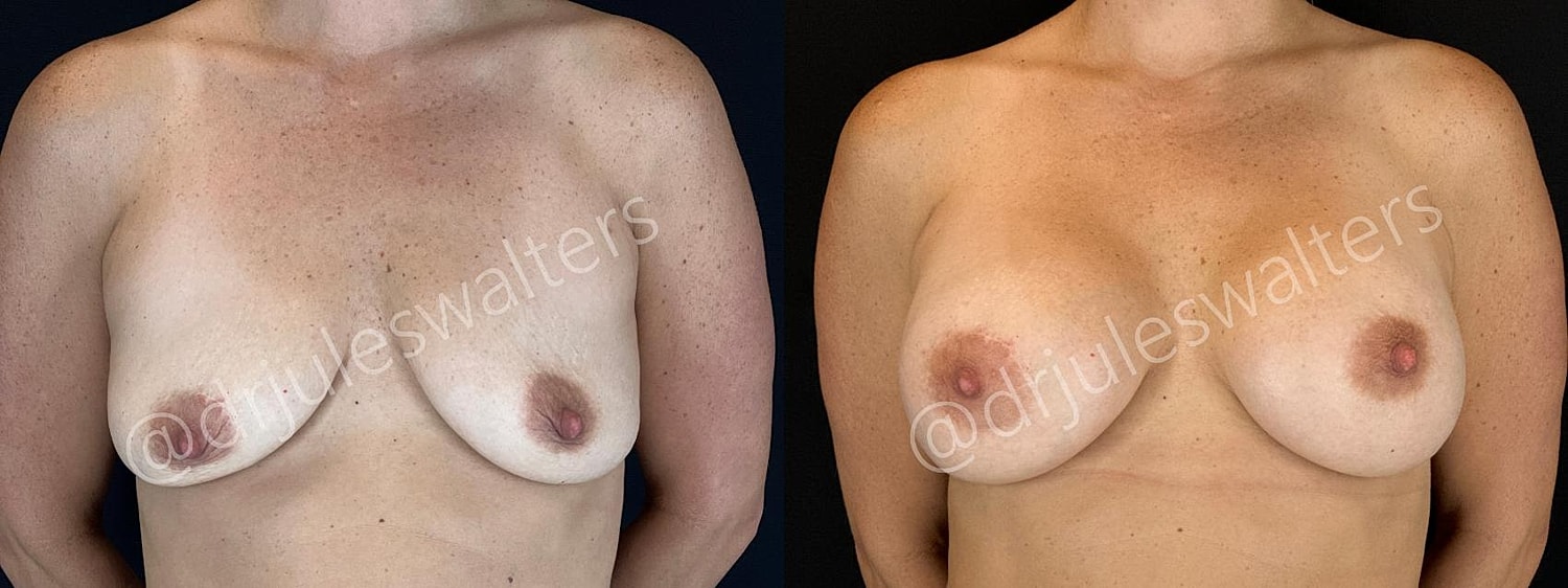 Breast Augmentation Before & After