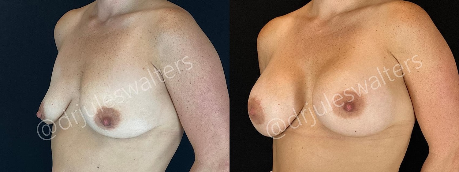 Breast Augmentation Before & After