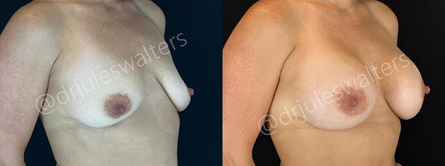Breast Augmentation Before & After