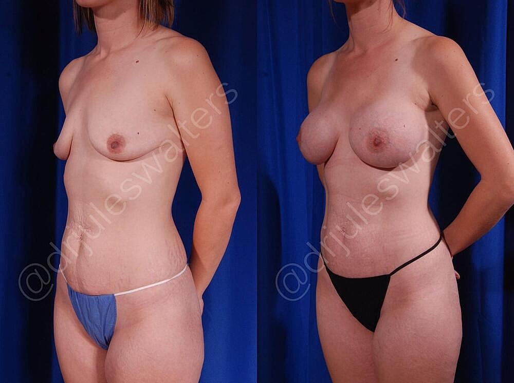Breast Augmentation Before & After