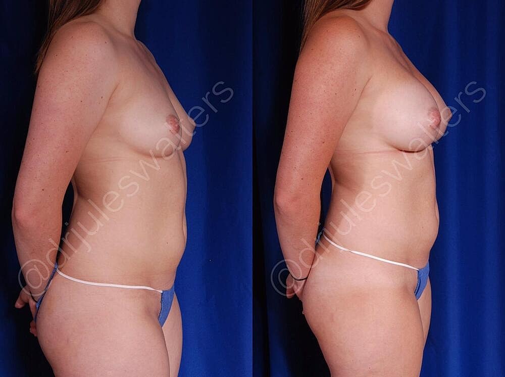 Breast Augmentation Before & After