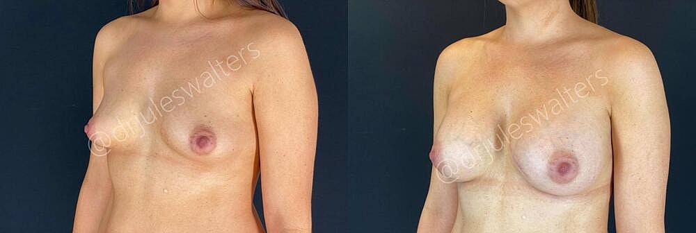 Breast Augmentation Before & After