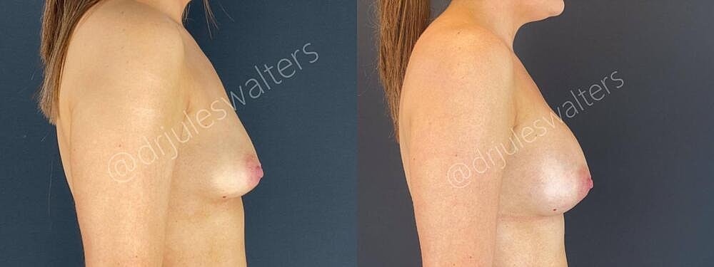 Breast Augmentation Before & After