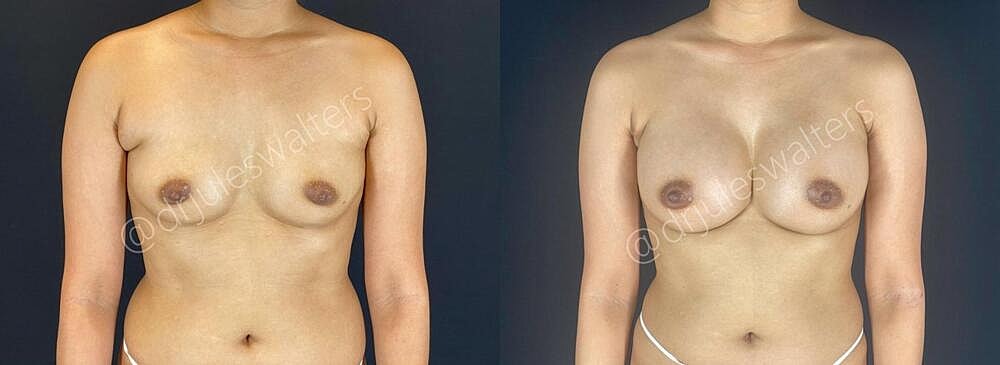 Breast Augmentation Before & After