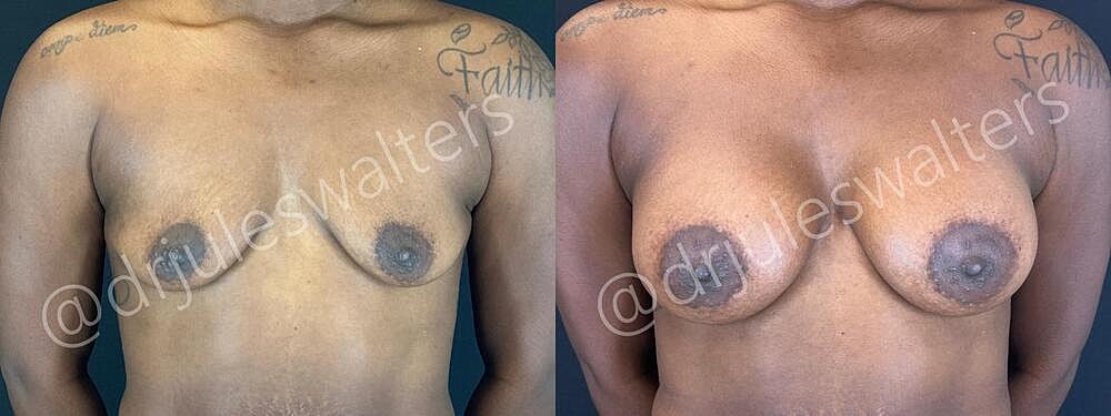 Breast Augmentation Before & After