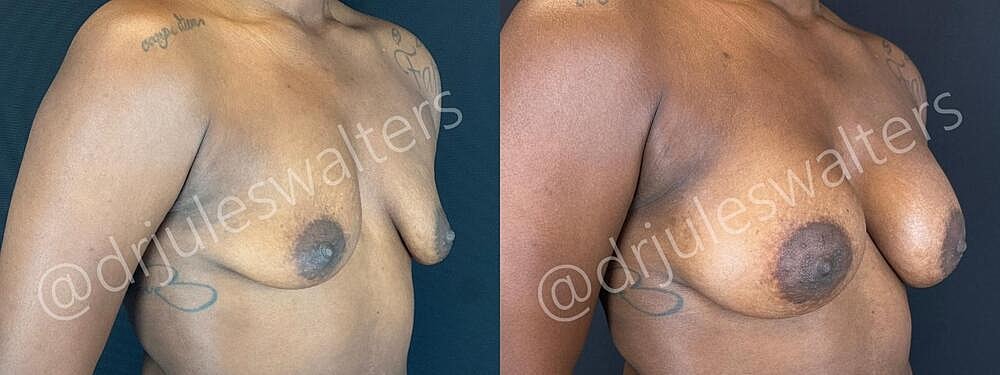 Breast Augmentation Before & After