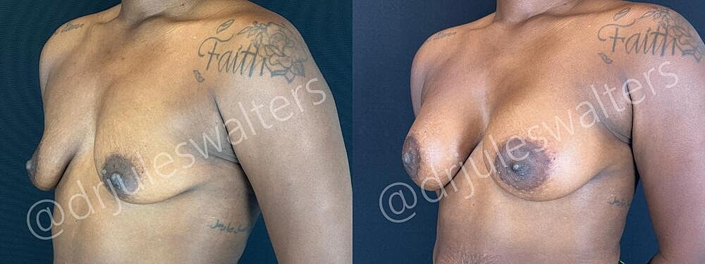 Breast Augmentation Before & After