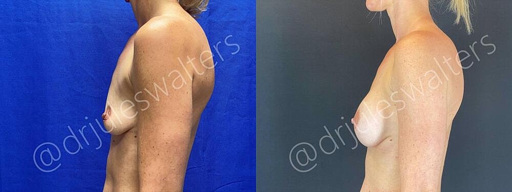 Breast Augmentation Before & After