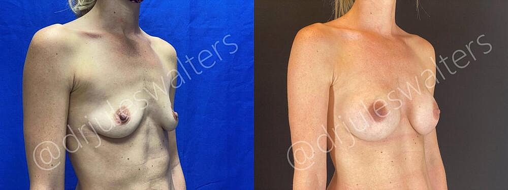 Breast Augmentation Before & After