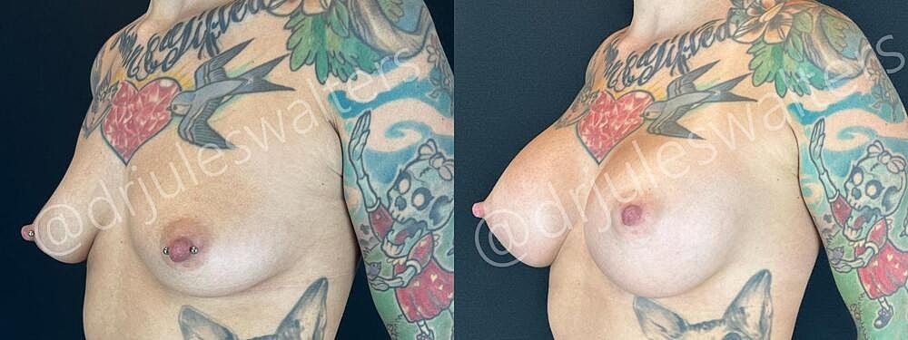 Breast Augmentation Before & After