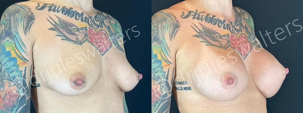 Breast Augmentation Before & After
