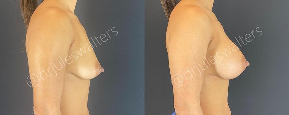 Breast Augmentation Before & After