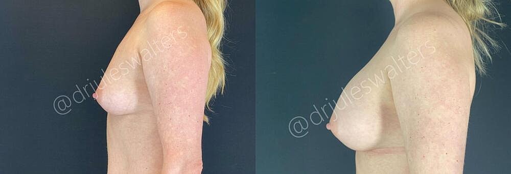 Breast Augmentation Before & After