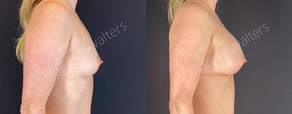 Breast Augmentation Before & After