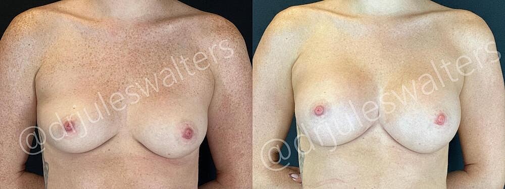 Breast Augmentation Before & After