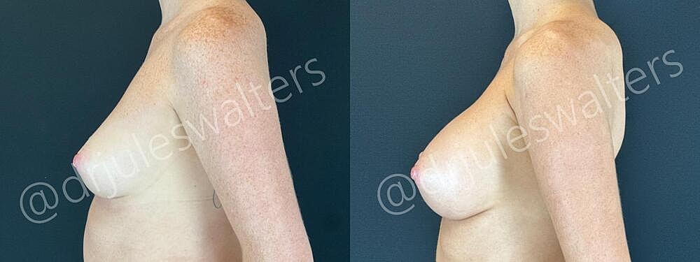 Breast Augmentation Before & After
