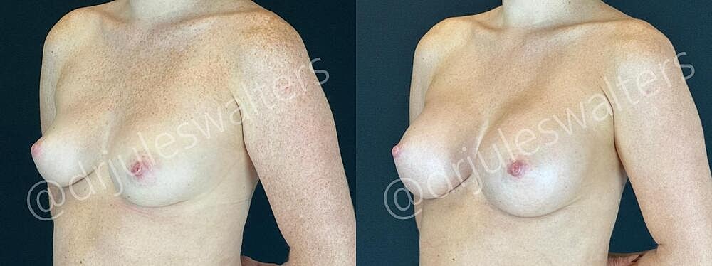 Breast Augmentation Before & After