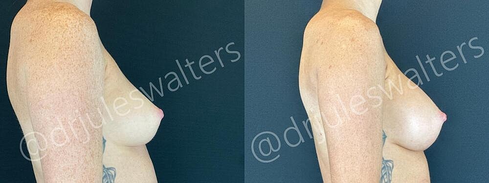 Breast Augmentation Before & After
