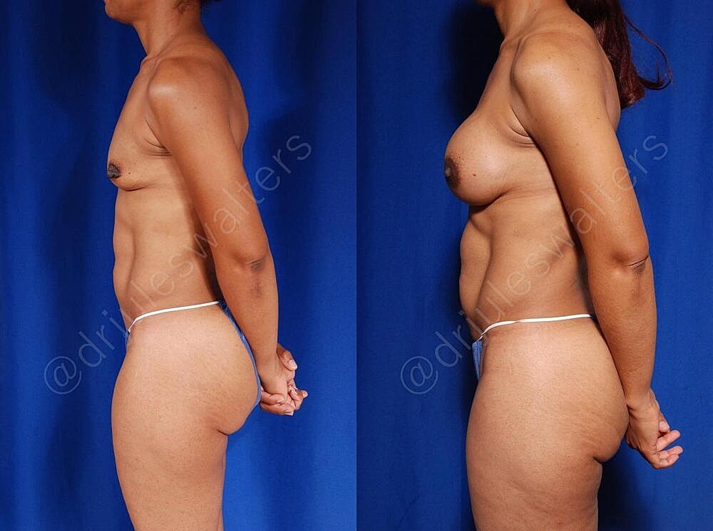 Breast Augmentation Before & After